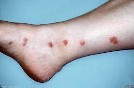 Maybe you would like to learn more about one of these? Insectenbeten Huidarts Com