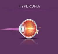 Lasik Fort Myers Lasik Surgery Naples Lasik Cape Coral