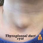 What causes a lump in your neck. What To Do If You Discover A Lump On Your Child S Neck Healthychildren Org