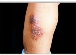 We did not find results for: Discoid Nummular Eczema In An Infant Download Scientific Diagram