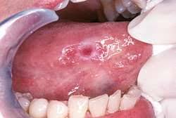 Image result for dental cancer
