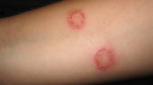 Other conditions that occasionally look like ringworm include look), and even lupus. Nummular Eczema Vs Ringworm What S The Difference