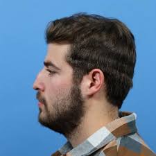 Rhinoplasty Before and After