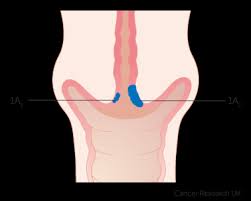 The most common and fearsome type of cancer among women is also one of the most highly preventable and treatable forms of cancer.cervical cancer screenings have saved thousands of lives by diagnosing alterations early enough to start an effective treatment. Stage 1 Cervical Cancer Cancer Research Uk