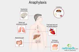 An itchy rash, throat or tongue swelling, shortness of breath, vomiting. Anaphylaxis Causes Symptoms And Treatment