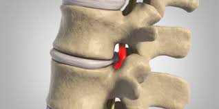 Maybe you would like to learn more about one of these? Florida Spine Surgeons Nuvasive