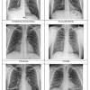 The most common copd conditions are emphysema. 1