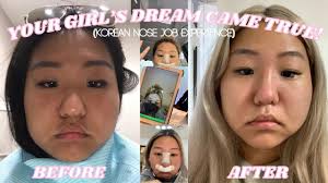 my dream has finally come true: I GOT A NOSE JOB IN KOREA