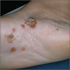 They last for about two or three weeks and may be related to seasonal allergies or even stress in other cases. Itchy Blisters On Feet Mdedge Family Medicine