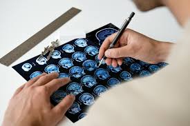 Die abkürzung für amyotrophe lateralsklerose ist als. Lou Gehrig Krankheit Und Die Schaden Des Nervensystems