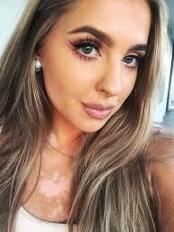 Kašlem na komplexy, som krásna! Odkazuje Anna, ktorá vitiligo odmieta viac  skrývať