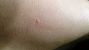 Image result for bedbug bites look like
