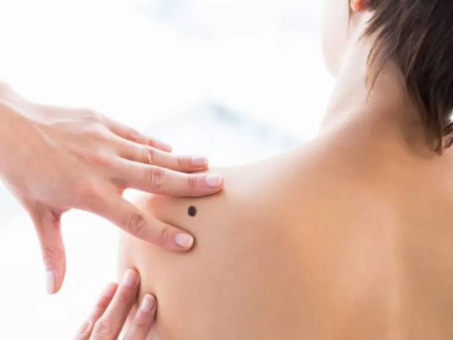 Nốt ruồi bị ngứa: Dấu hiệu sớm cảnh báo ung thư da? • Hello Bacsi