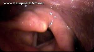 Image result for Vocal Cord Dysfunction