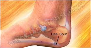 One Of The Common Causes Of Heel Spur Is Recurrent Stress To The Base Of The Heel Which Results In Buildup Of Heel Spurs Bones And Muscles Plantar Fascia Tear