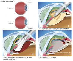 Image result for Cataract Extraction
