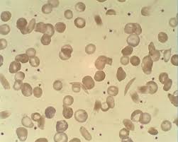 Bei homozygot erkrankten sind alle erythrozyten betroffen. Sichelzelle Doccheck Flexikon