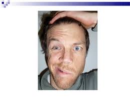 It is one of the most common neurologic disorders of the cranial nerves. Bell S Palsy Brief Ppt