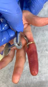 Image result for Ring Removal