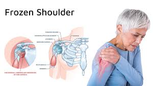 Image result for Frozen Shoulder