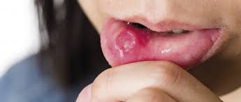 Vor allem wird das aussehen einer person beschädigt. Dermatologie Was Tun Bei Trockenen Lippen Und Rhagaden