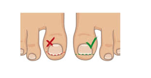 Image result for Akutní zánět nehtového lůžka