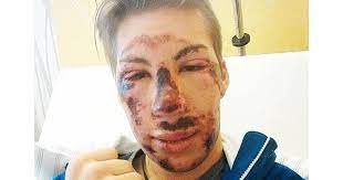 Thomas diethart gewann vor sechs jahren aus dem nichts die vierschanzentournee. Skispringer Thomas Diethart Postet Nach Schwerem Sturz Ein Schock Foto