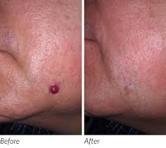 If you are diagnosed with basal cell or squamous cell cancer, the entire cancerous lesion may be removed at the time of the skin biopsy or soon after. Radiofrequency Mole Removal Naturopathic Doctor News And Review