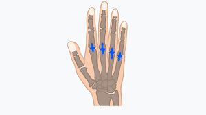 Arthrose In Den Handen Wie Es Zu Schmerzen Im Fingergelenk Kommen Kann Lime Medical Gmbh Lime Medical Gmbh