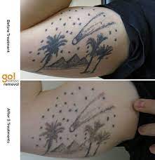 Pin On Tattoo Removal In Progress