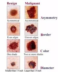 Your immediate family members have many moles, atypical moles, or a history of skin cancer. Does A New Mole On My Face Indicate Skin Cancer Quora