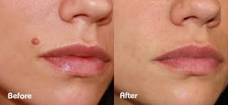 However, if you want them to get removed from your skin, there are a few common. Cryopen Cryotherapy Salon Savant