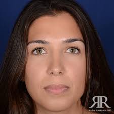 The Aging Rhinoplasty What Happens In The Long Term