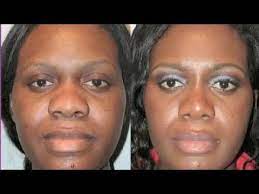 Following cosmetic nose job surgery, her nasal tip. Pin On Stones Crystals Etc