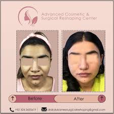 Advanced Cosmetic and Surgical Reshaping Center (@dr.abdulsamee) •  Instagram photos and videos