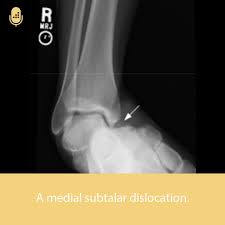 Image result for Subtalar Dislocation