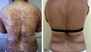 Clinical Appearance Before A And After B Methotrexate Therapy Download Scientific Diagram