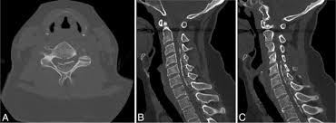 Degenerative change of the ligamentum flavum can result in elastic fibers being replaced with collagen. Ossification Of The Ligamentum Flavum A Unique Report Of A Hispanic Woman In Neurosurgical Focus Volume 30 Issue 3 2011