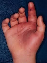 Image result for phlegmon of hand)