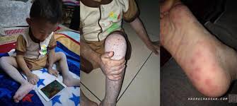Apakah pns tersebut dapat memohonkan cuti sakit tambahan? Cuti Kuarantin 5 Penyakit Berjangkit Khas Kakitangan Awam Jaga Anak Di Rumah