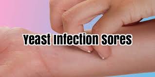 Yeast Infection Sores Yeastinfection Yeast Infection Infections Yeast