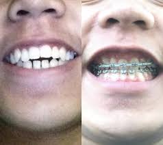 This is usually only an option for those that have a gummy smile due to severe grinding. I Have Retroclined Teeth I Have Had Braces For 2 Years Now And I Am Not Happy With My Teeth I Have A Gummy Smile And My Bottom Teeth Are Pointing Inward