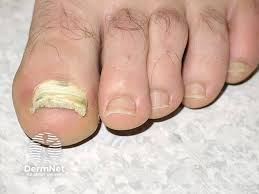Image result for onychomycosis