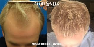 The chemicals can change the color of your hair and weaken it, which could cause it to eventually fall out. My Life Changing Hair Transplant Hasson Wong