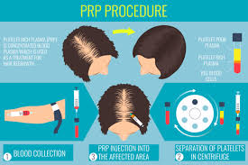 Amplixin energizing conditioner works to get deep into the scalp to moisturize hair follicles and improve thickness. Platelet Rich Plasma Prp Therapy For Hair Loss La Jolla Sd