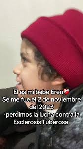 Esclerosis Tuberosa Bebes