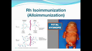 Image result for Rh Sensitization