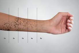 As you look at that old tattoo from the summer before college, you may find yourself wondering how much it costs to get a tattoo removed. Laser Tattoo Removal How Much Does Laser Removal Of A Tattoo Cost