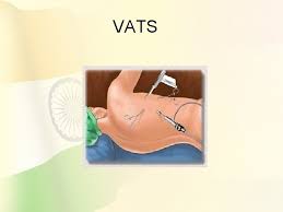 This page was updated on april 2, 2021. Anaesthesia For Thoracoscopy Vats Bal Mediastinoscopy And Esophagoscopy