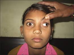 Image result for Pupillary Paralysis